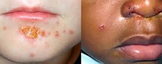 Restoring Skin Health: Understanding and Treating Skin and Soft Tissue Infections